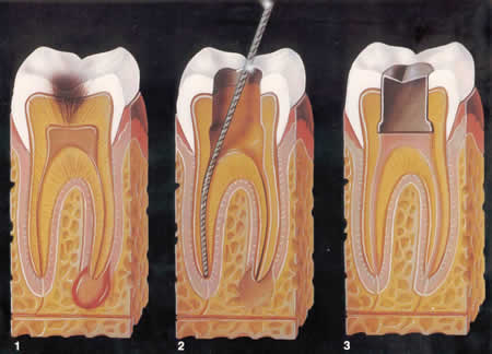 Fases del tratamiento de endodoncia