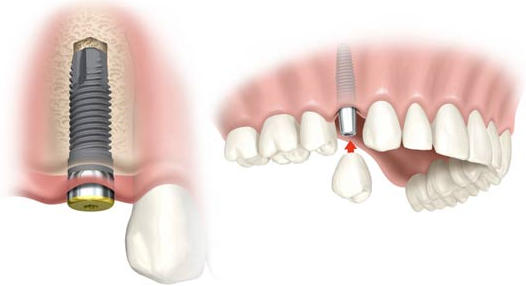 implamte denta en Valencia,