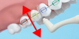 La Higiene bucal cuando se utiliza Ortodoncia