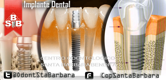 Implante dental, La solucion definitiva a la perdida dentarea
